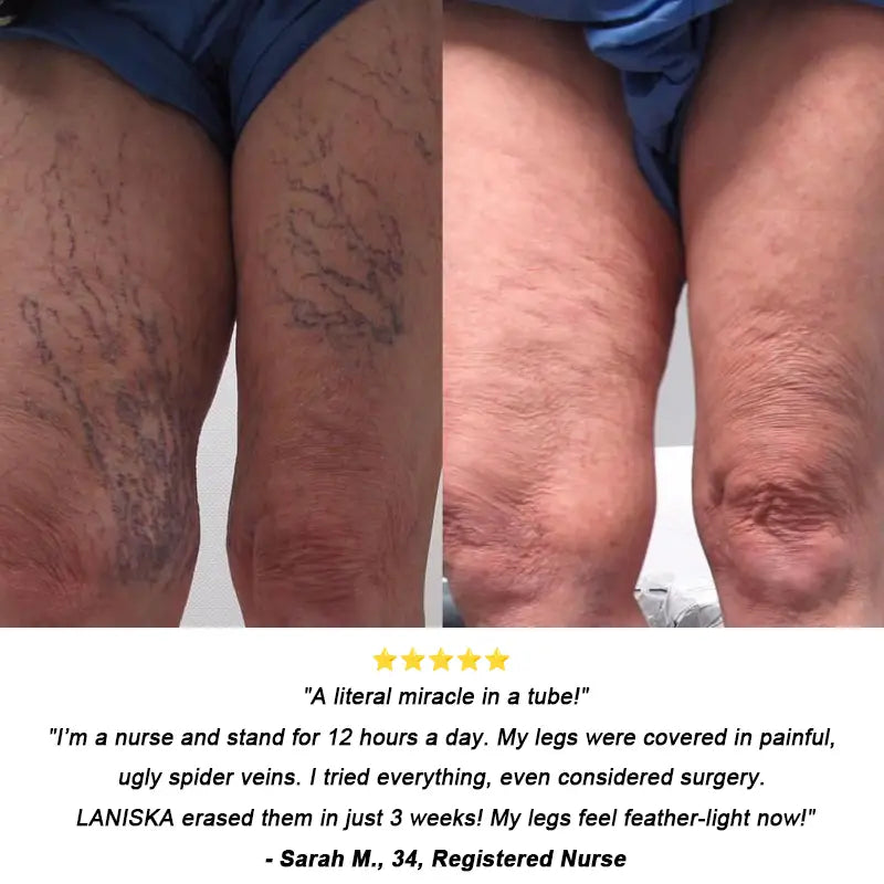 𝐎𝐟𝐟𝐢𝐜𝐢𝐚𝐥 𝐔𝐒 𝐒𝐭𝐨𝐫𝐞 ⭐💖🇺🇸  | EPIGENIX® 🛑 Instant Varicose Vein Relief Cream | Erase "Earthworm" Veins Fast & Stop Pain