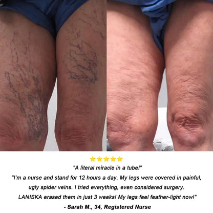 𝐎𝐟𝐟𝐢𝐜𝐢𝐚𝐥 𝐔𝐒 𝐒𝐭𝐨𝐫𝐞 ⭐💖🇺🇸  | EPIGENIX® 🛑 Instant Varicose Vein Relief Cream | Erase "Earthworm" Veins Fast & Stop Pain