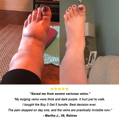 𝐎𝐟𝐟𝐢𝐜𝐢𝐚𝐥 𝐔𝐒 𝐒𝐭𝐨𝐫𝐞 ⭐💖🇺🇸  | EPIGENIX® 🛑 Instant Varicose Vein Relief Cream | Erase "Earthworm" Veins Fast & Stop Pain