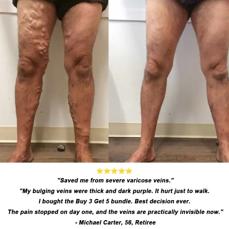 𝐎𝐟𝐟𝐢𝐜𝐢𝐚𝐥 𝐔𝐒 𝐒𝐭𝐨𝐫𝐞 ⭐💖🇺🇸  | EPIGENIX® 🛑 Instant Varicose Vein Relief Cream | Erase "Earthworm" Veins Fast & Stop Pain